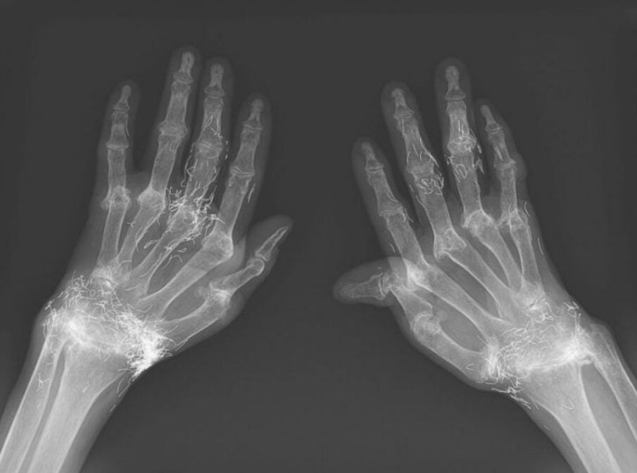 کشف صدها رشته طلای خالص در زانوی زن مبتلا به آرتروز کشف صدها رشته طلای خالص در زانوی زن مبتلا به آرتروز