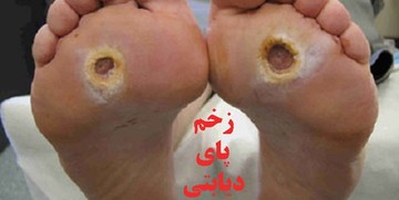 خطرناک‌ترین بیماری در کمین دیابتی‌ها/ توصیه‌هایی برای مبتلایان به پای دیابتیک