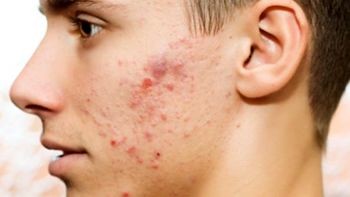 آکنه را چطور درمان کنیم؟