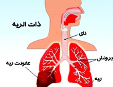 روز جهانی ذات‌الریه