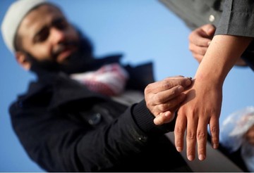 درمان با نیش زنبور عسل