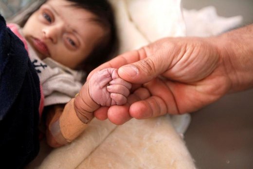 کودکی که دچار سوءتغذیه شده و در یک مرکز درمانی در شهر صنعا بستری بود دو روز بعد از این عکس درگذشت