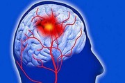 سکته مغزی چه زمانی قابل درمان است؟