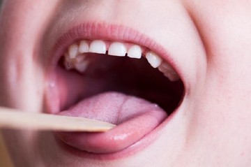 تشخیص زودهنگام سرطان پانکراس با استفاده از باکتری‌های زبان
