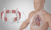 ایمپلنت نخستین پمپ قلب بی‌سیم جهان با موفقیت انجام شد