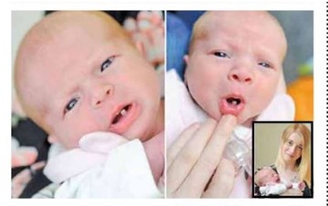 دختری که با یک دندان به دنیا آمد/ عکس