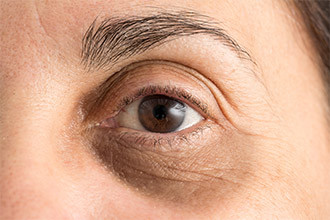 علت‌ها و روش‌های درمان سیاهی دور چشم