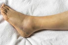 ورم مچ پا چه دلایلی دارد؟/ این علائم را جدی بگیرید