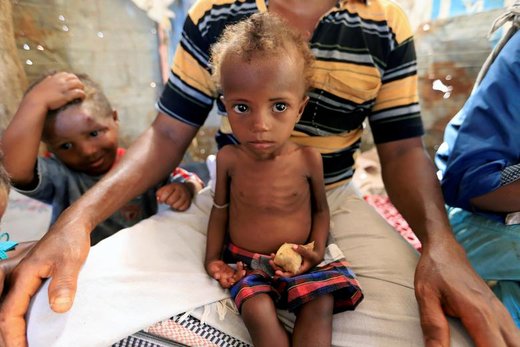 یک دختر بچه مبتلا به سوءتغذیه در آغوش پدرش در شهر حدیده یمن نشسته است