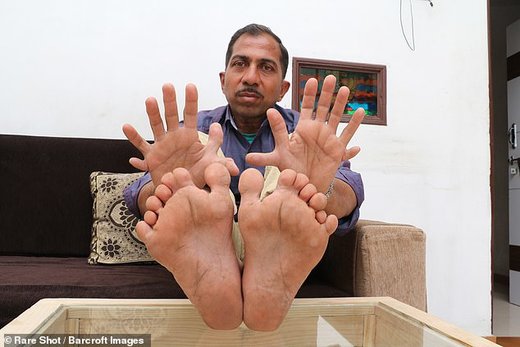 مرد هندی با 28 انگشت