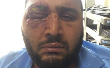 عکسی دلخراش از هوادار پرسپولیس که در بازی با سپاهان چشمش را از دست داد