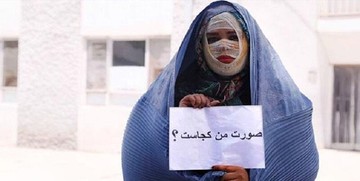 معروف‌ترین قربانی اسیدپاشی: هنوز دیه‌ام را نگرفته‌ام