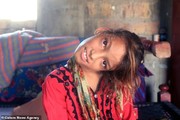 «کج گردنی»، اختلال عجیب دختر ۱۱ ساله پاکستانی/ تصاویر