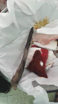 نجات جان دختربچه ۹ ساله لردگانی در اتاق عمل بیمارستان شهدا لردگان