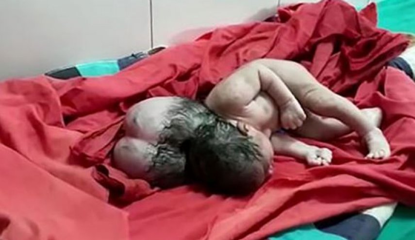 تولد نوزادی با ۳ سر پزشکان را شوکه کرد! + عکس
