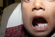فیلم | کشف ۵۲۶ دندان در دهان کودک هندی!