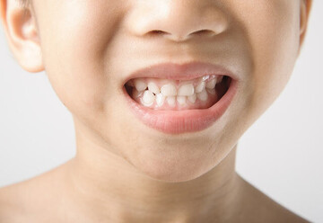 چرا کودکان به دندان‌قروچه مبتلا هستند؟