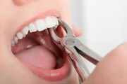 زیبایی به سبک تیک تاک: مرتب و سفید کردن دندان‌ها با سوهان ناخن و هیدروژن پروکسید/ تصویر