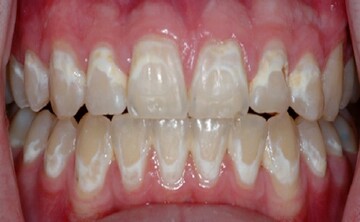علت وجود لکه‌های سفید روی دندان‌ها چیست؟