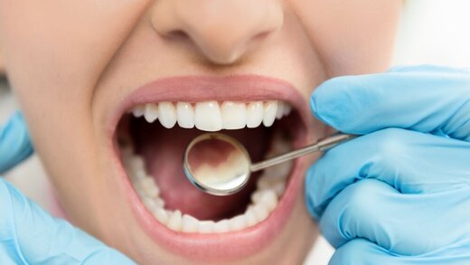 Image result for ایمپلنت‌های دندانی"