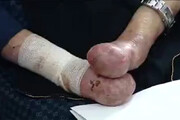فیلم | مرگ ۱۵ بیمار ایرانی به علت نبودن پانسمان!