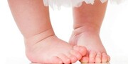 پای پرانتزی نوزادان در چه سنی قابل تشخیص است؟