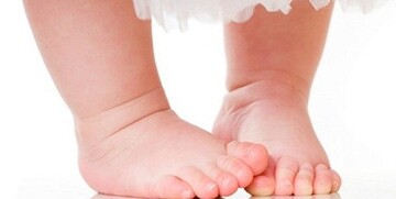 پای پرانتزی نوزادان در چه سنی قابل تشخیص است؟
