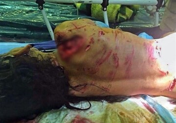 آخرین وضعیت دخترک گلفروش که مورد حمله سگ‌ها قرار گرفت
