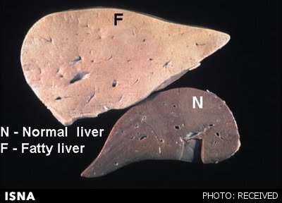 تاثیر کرونا بر بیماری کبد چرب