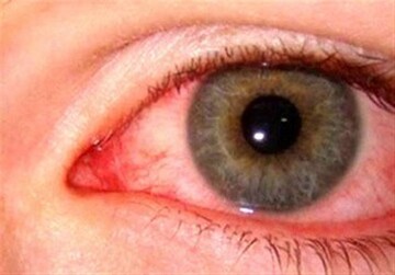 چشم‌ها می‌توانند تا هفته‌ها منبع انتقال ویروس کرونا باشند
