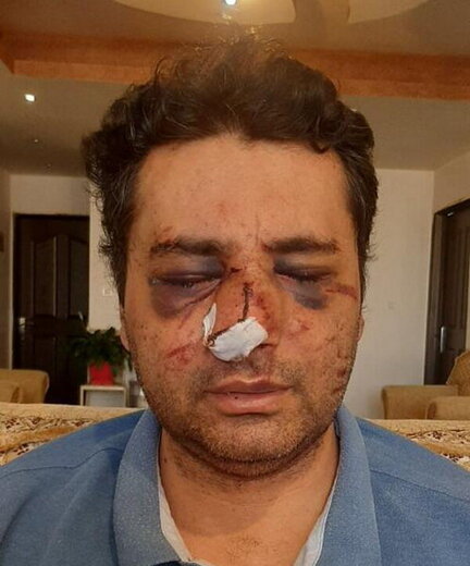 ضرب و شتم شدید یک متخصص بیهوشی توسط همراهان یک بیمار در پیرانشهر/ تصویر 
