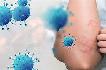 ببینید | مشخصات نشانه‌های پوستی کرونا