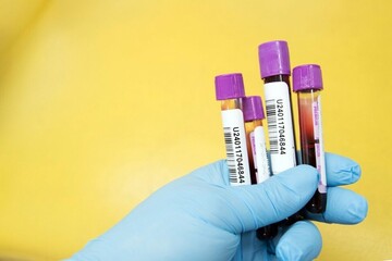 تشخیص موارد خطرناک کرونا با آزمایش خون