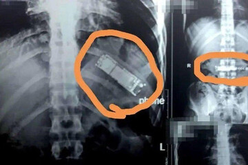 ببینید | نجات یک بیمار از خطر انفجار معده!