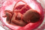 هشدار متخصصان درباره حذف برنامه غربالگری جنین