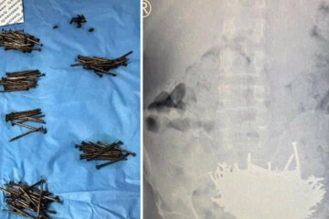 ببینید | خارج کردن ۲۳۰ میخ و قطع شیشه از شکم یک بیمار