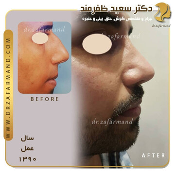  جراحی بینی برای بار دوم و چالش های آن