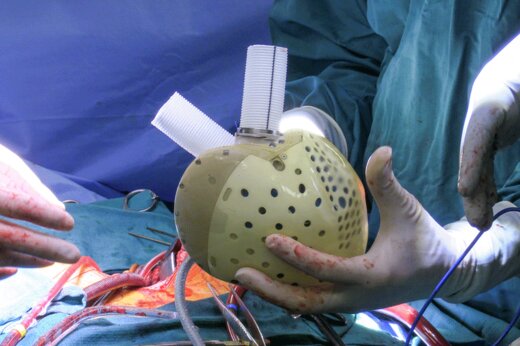 ببینید | پزشکی روی موج پیشرفت؛ اولین پیوند قلب مصنوعی در ایتالیا