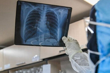 ببینید | نشانه‌های درگیری ریه در مبتلایان به ویروس کرونا