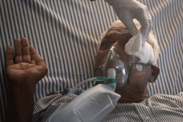 زالی: ۵۶ بیمار قارچ سیاه در تهران بستری هستند