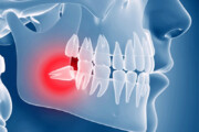 اینفوگرافیک | بایدها و نبایدهای کشیدن دندان عقل