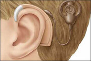 ششمین عمل جراحی کاشت حلزون شنوایی در دانشگاه علوم پزشکی بابل