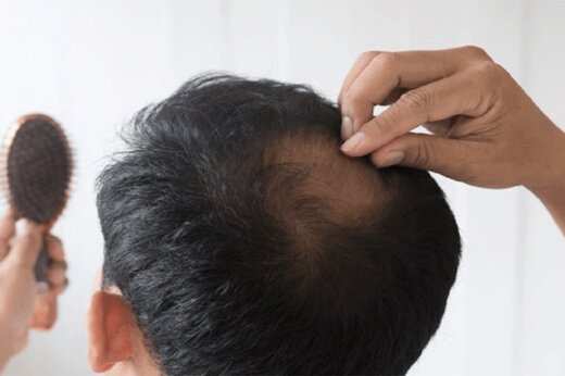پنج عامل مهم ریزش موها را بشناسید 