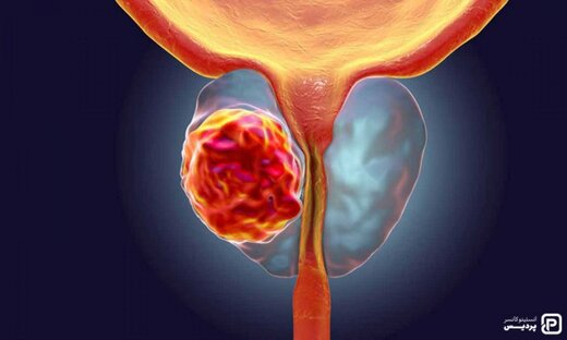 نشانه‌های سرطان پرستات در مردان چیست؟