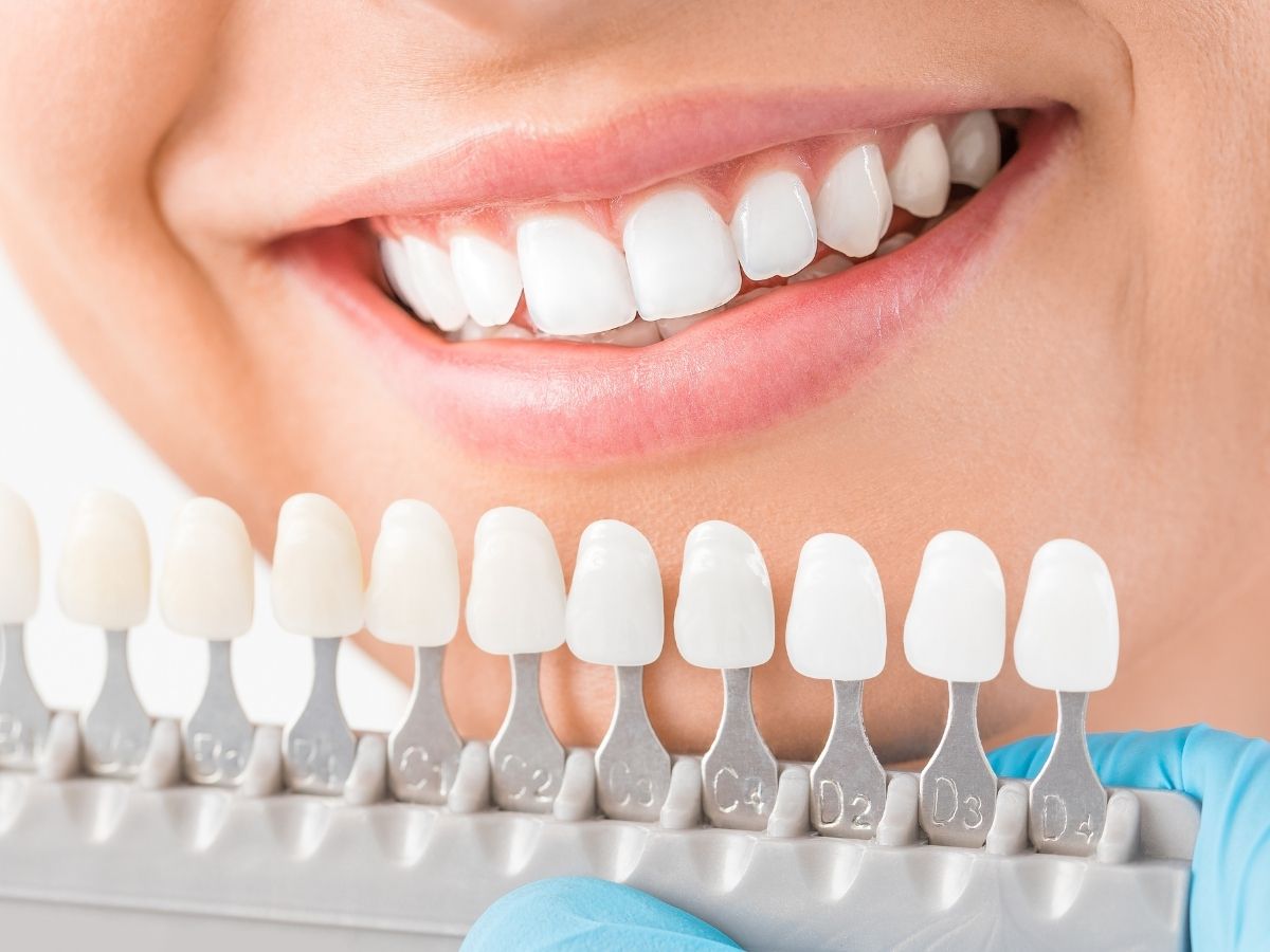 بهترین روش سفید کردن دندان ها 