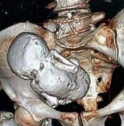 جنین سنگی در رحم یک زن ۷۳ ساله/ عکس