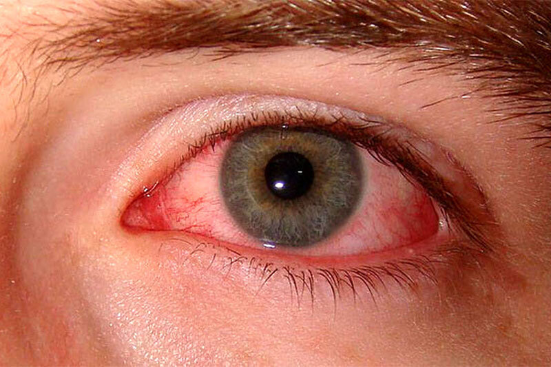 ببینید | قرمزی چشم دلیل چه بیماری‌هایی است؟