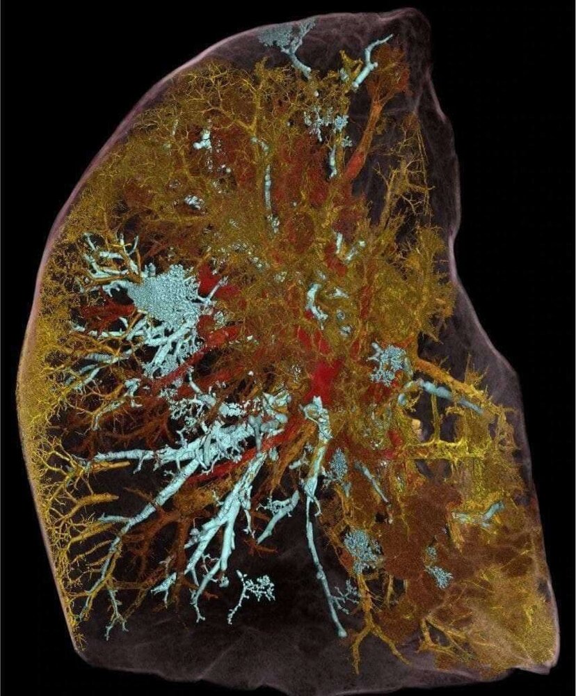 عکس | تصویری جدید از یک مرد فوت شده بر اثر کرونا با قوی‌ترین دستگاه ایکس‌ری جهان
