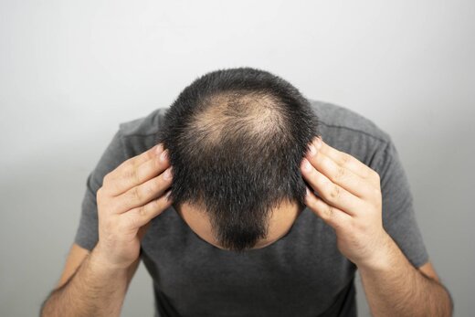 ترمیم و رشد موهای ریخته شده در سریع ترین زمان