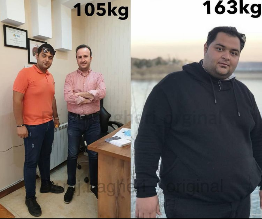 شایعاتی در رابطه با اسلیو معده که حقیقت ندارد